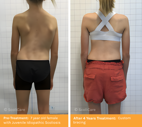 Juvenile Scoliosis