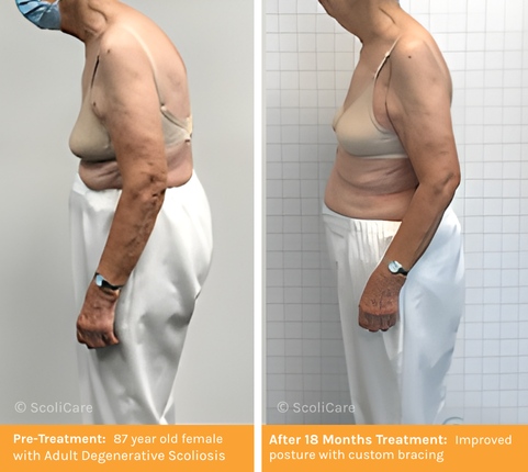Adult Scoliosis