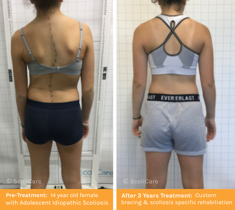 Adolescent Idiopathic Scoliosis